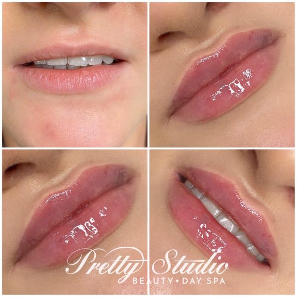 Baby Doll Lips Powiekszanie Ust Powiększanie ust metodą Baby Doll Lips | Pretty Studio - Beauty & Day SPA