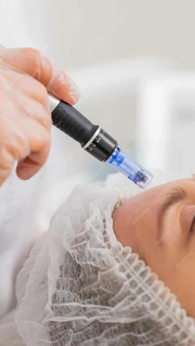 Na pewno potrzebujesz tego zabiegu!

— Mezoterapia mikroigłowa to zabieg polegający na kontrolowanym nakłuwaniu skóry cienkimi igiełkami, który stymuluje jej regenerację i wspomaga wchłanianie substancji aktywnych.

✔️Wskazania do zabiegu:

▫️zmarszczki i utrata elastyczności,
▫️rozszerzone pory i nierówności skóry,
▫️przebarwienia i blizny potrądzikowe,
▫️suchość i wiotkość skóry,
▫️rozstępy i oznaki starzenia.

✔️Efekty po zabiegu:

▫️wygładzenie i ujędrnienie skóry,
▫️redukcja zmarszczek i blizn,
▫️poprawa kolorytu i tekstury,
▫️głębokie nawilżenie,
▫️młodszy i zdrowszy wygląd cery.

Umów się na konsultację przez link w bio📩