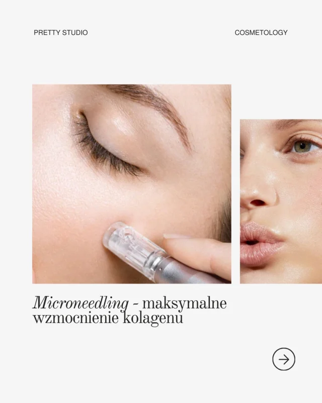 Microneedling: najlepsze wzmocnienie kolagenu 

— Szukasz sposobu na wygładzenie drobnych zmarszczek, rozjaśnienie blizn i poprawę struktury skóry? Mikronakłuwanie to idealny zabieg dla jędrniejszej i bardziej promiennej cery!

💉 Jak to działa:
Mikroskopijne kanały stymulują produkcję kolagenu i elastyny, wspierając naturalną odnowę skóry od wewnątrz.

Czego możesz się spodziewać:
✔️Zaczerwienienie po zabiegu jest całkowicie normalne i zazwyczaj ustępuje w ciągu 24–48 godzin
✔️Może pojawić się lekkie przesuszenie lub łuszczenie się skóry, co świadczy o jej regeneracji
✔️Najlepsze efekty osiąga się w serii zabiegów – regularność to klucz do sukcesu!

Rezerwacja konsultacji kosmetologicznej dostępna przez link w bio.