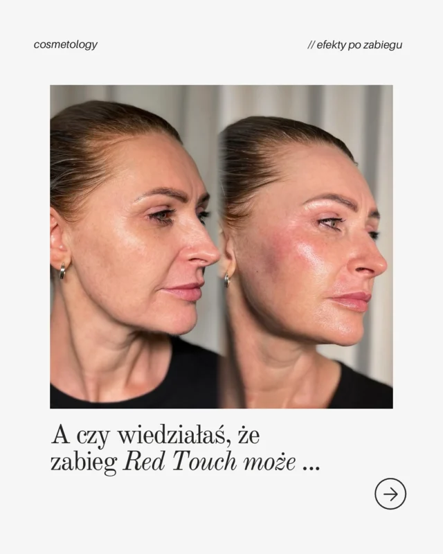 Odmłodzenie bez bólu i igieł? To możliwe z Red Touch!

— Red Touch to nowoczesna, bezinwazyjna technologia laserowa, która skutecznie stymuluje produkcję kolagenu, wygładza zmarszczki, poprawia jędrność i koloryt skóry✔️

Zabieg jest nieinwazyjny i bezpieczny, a efekty utrzymują się długo, dając Twojej skórze naturalny, zdrowy wygląd.

Umów się na konsultację przez link w bio!